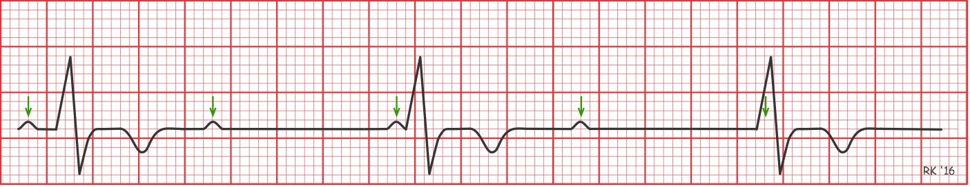 Third degree AV block